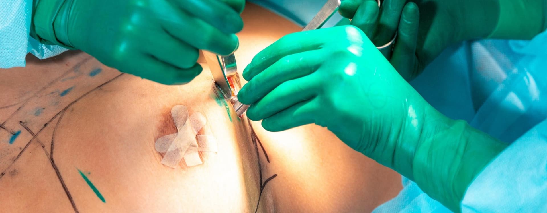Vorteile der Brustvergrößerung mit Eigenfett gegenüber Implantaten